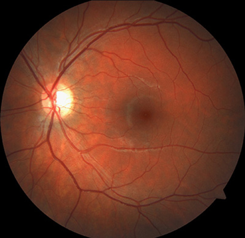retinal-photography